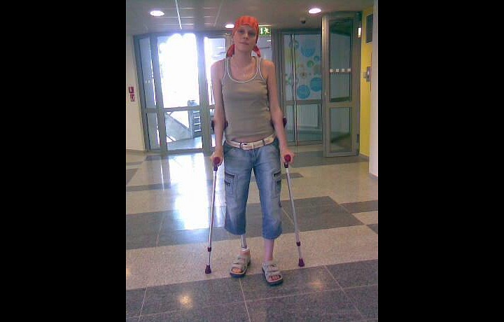 Naučila se chodit s protézou.