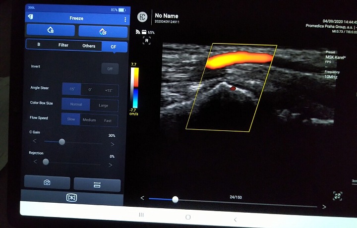 Obrazovka počítače při plicním skenování