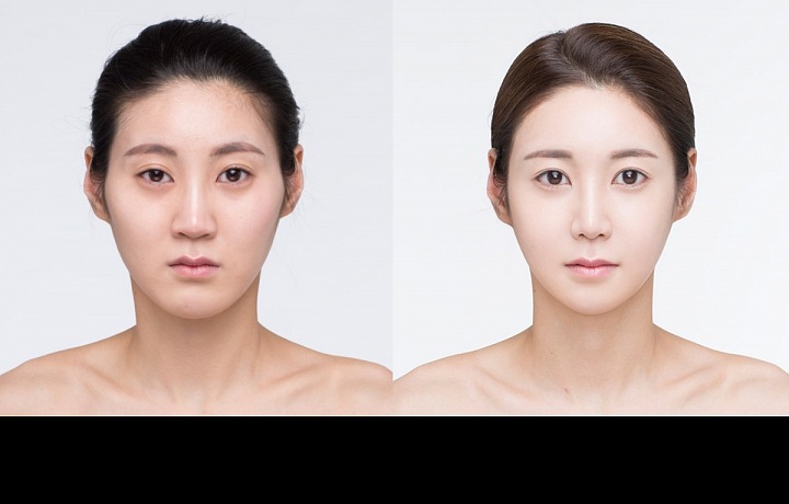Plastická operace ženy v Jižní Koreji
