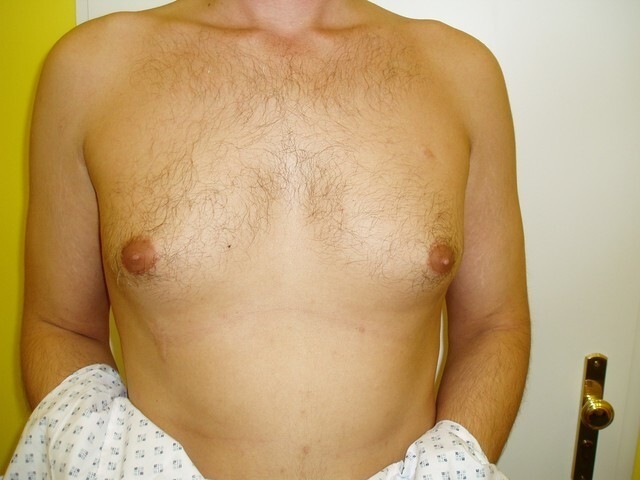 Mužské zvětšené poprsí? Začíná to být civilizační choroba. 