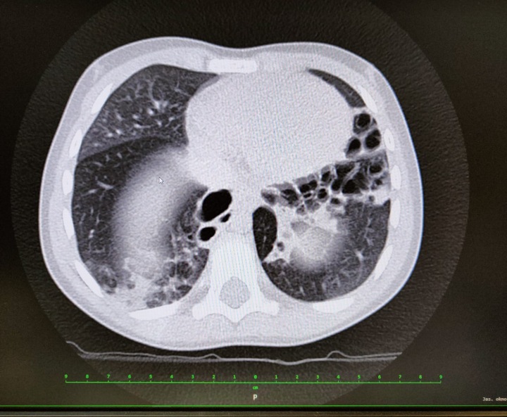 Rentgen Aniččiných plic. 
