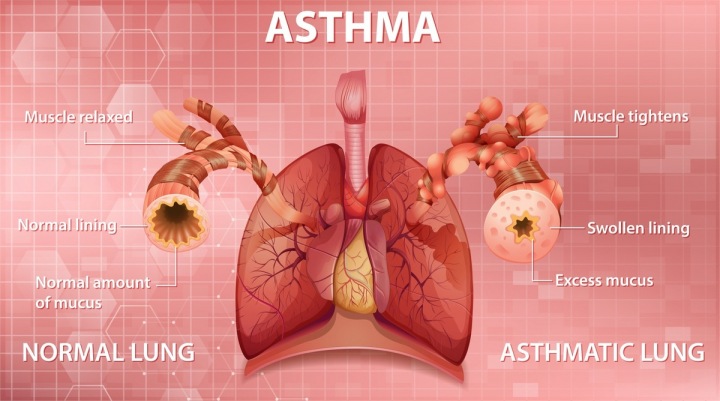 Astma schéma Astma schéma